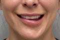 How To Fix A Wonky Smile Botox Complication: DAO/DLI Masterclass
