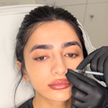 Nose Slimming & Tip Lift Botox Training